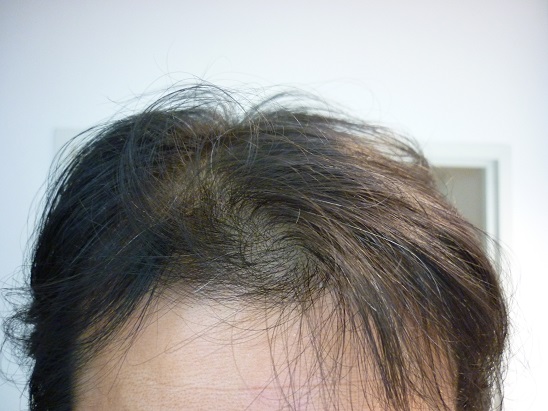 湿気に悩むコシのない髪 飲む育毛剤フィンペシアは６７週目 育毛剤で薄毛克服 おまけにアンチエイジング ハゲっと娘に呼ばれて